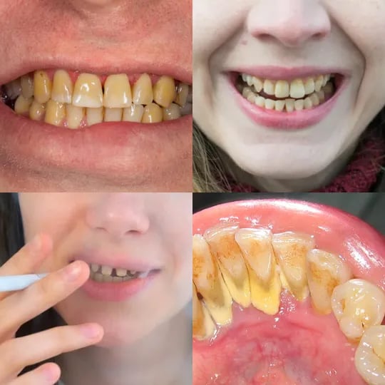 Sonrisas con dientes amarillos y manchas antes del blanqueamiento dental.