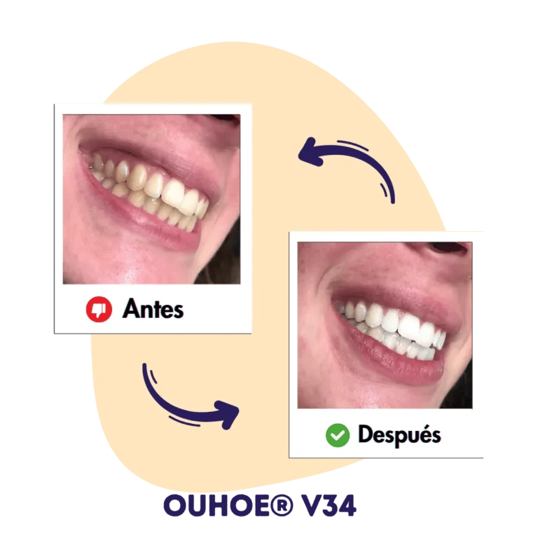 Sonrisa con dientes amarillos al lado de sonrisa con dientes blancos.